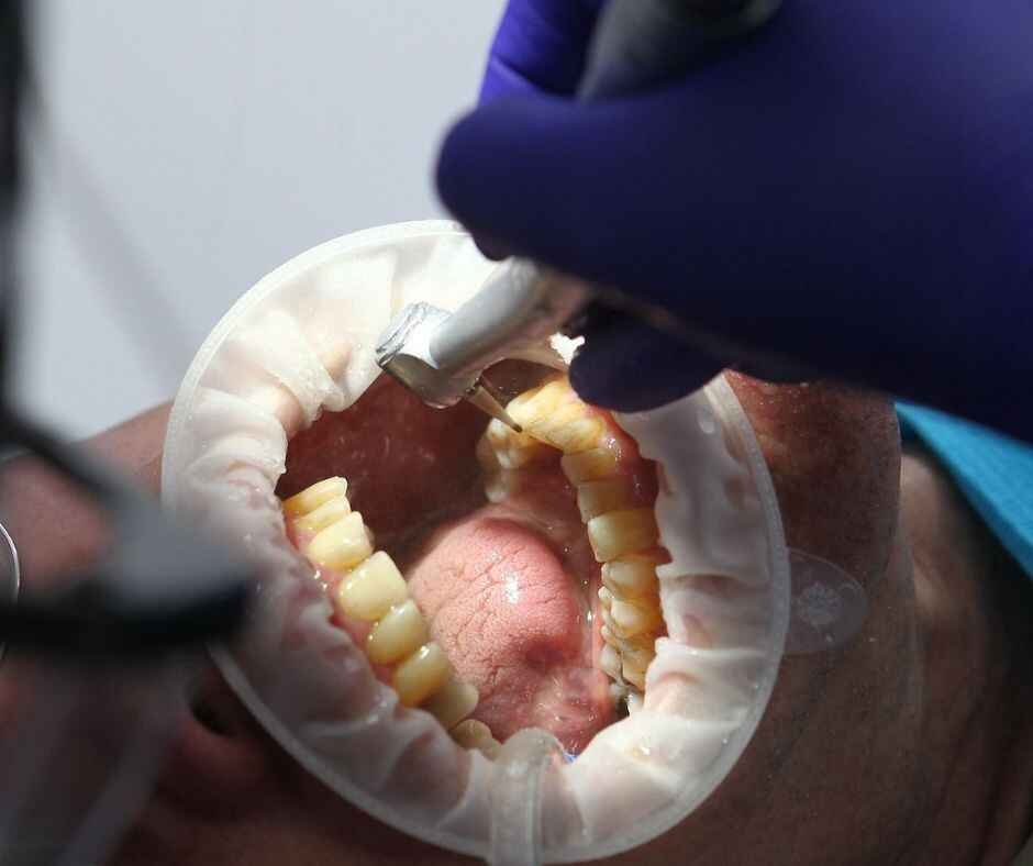 tooth treatement