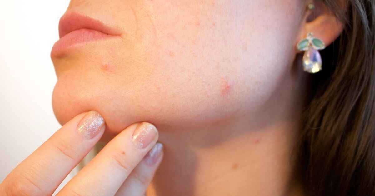 acne spot treatment